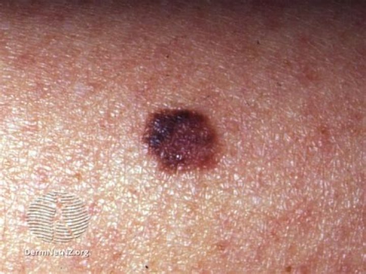 Are melanomas flat or raised?