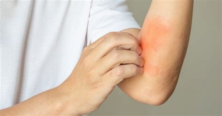 Can anemia cause itching?