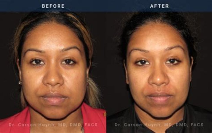 Can cheek fat be reduced?