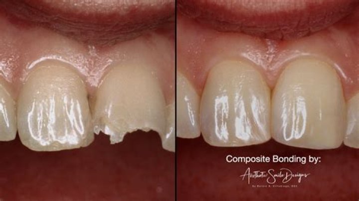 Can I use mouthwash with composite veneers?