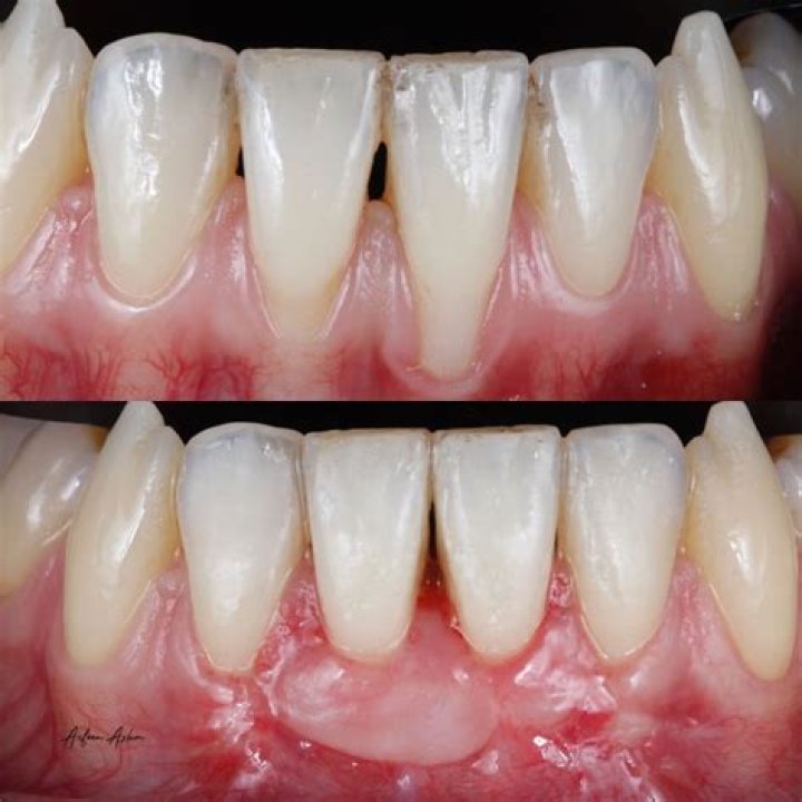Can I use toothpaste after gum graft?