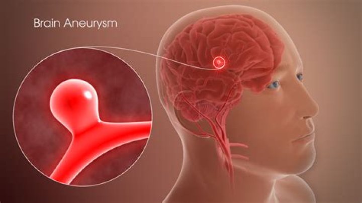 Can skydiving cause a brain aneurysm?