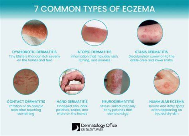 Can sweet cause eczema?