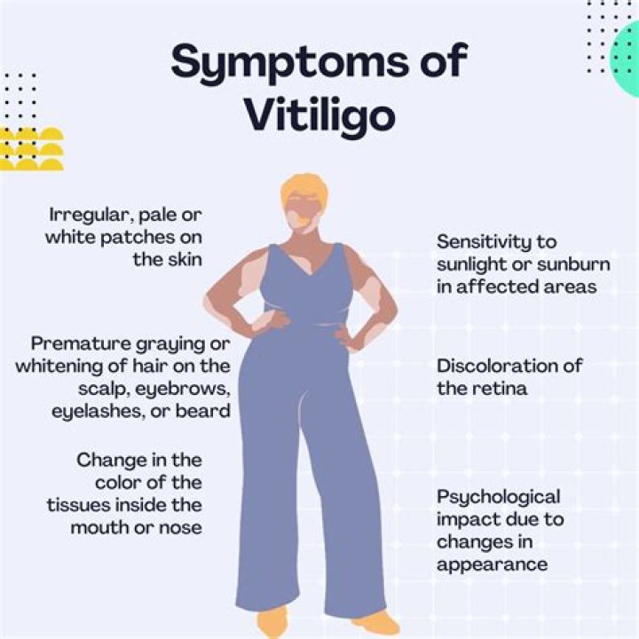 Can vitiligo appear at any age?