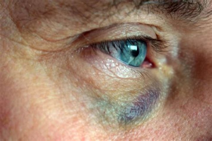 Can you get a black eye from hitting the back of your head?