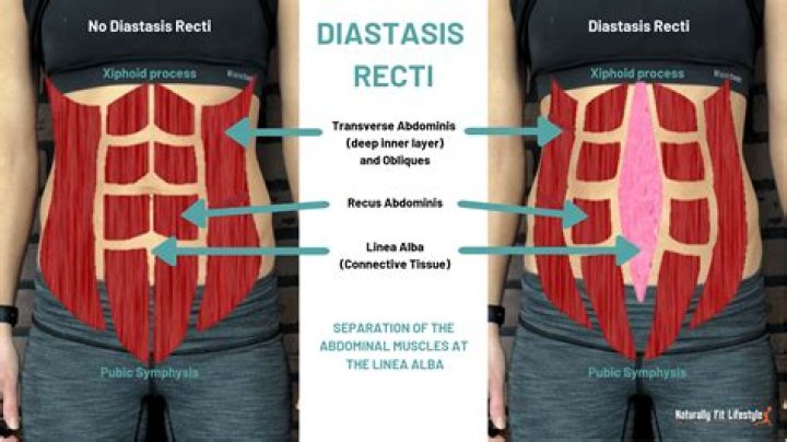 Can you heal diastasis recti without surgery?