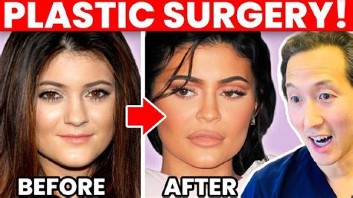 Did Alexis have plastic surgery?