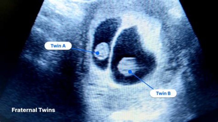 Do identical twins have different belly buttons?