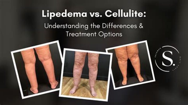 Do tights cover cellulite?