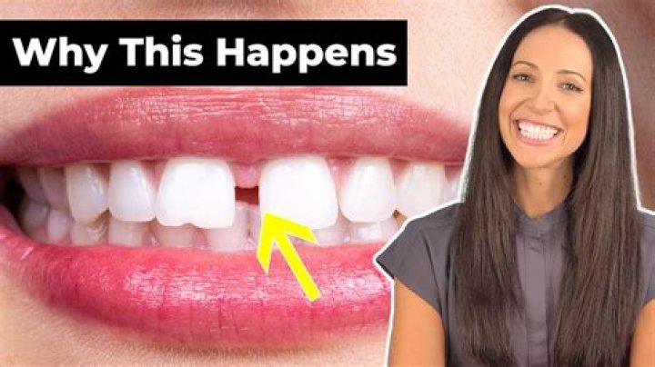 Does a gap in your teeth mean wealth?