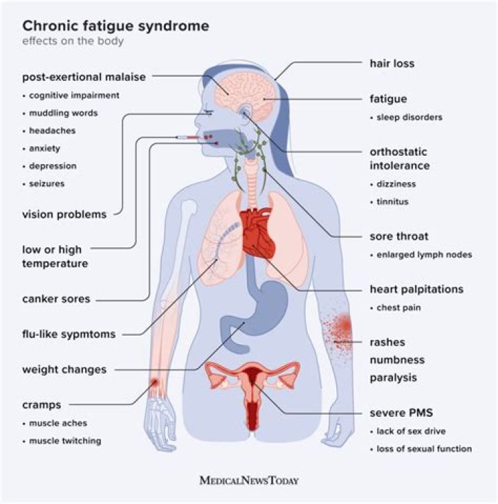 Does a rheumatologist treat chronic fatigue syndrome?