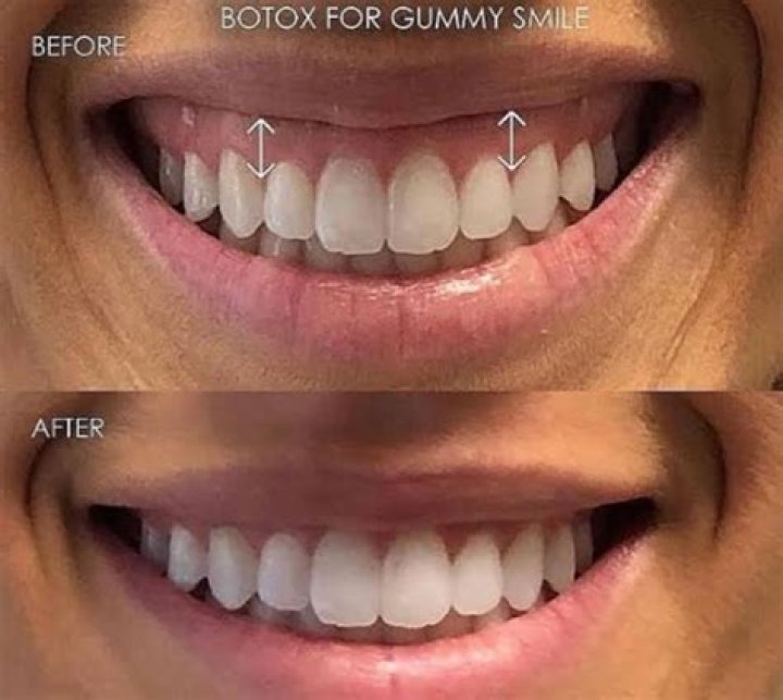 Does lip lift cause gummy smile?