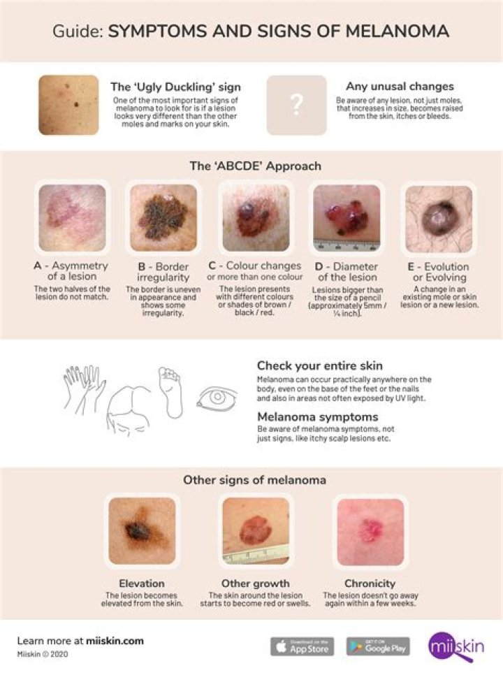 Does melanoma just appear suddenly?