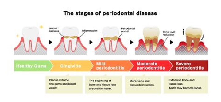 Does periodontal disease cause heart disease?