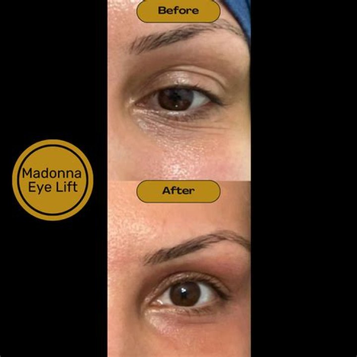 Does the Madonna eye lift work?