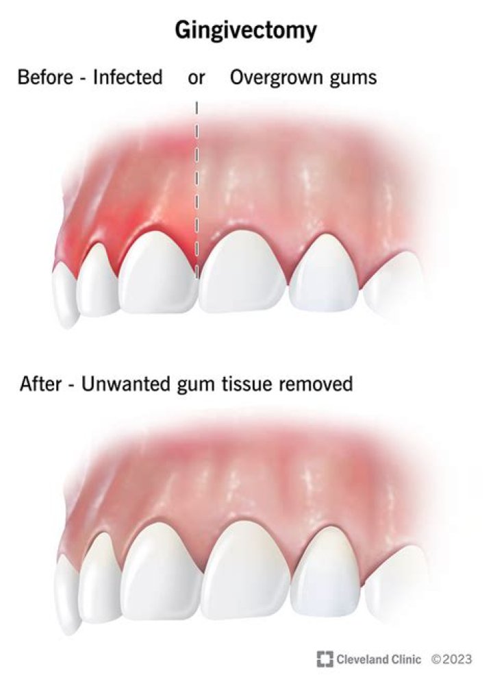 Does tissue grow back after gum graft?