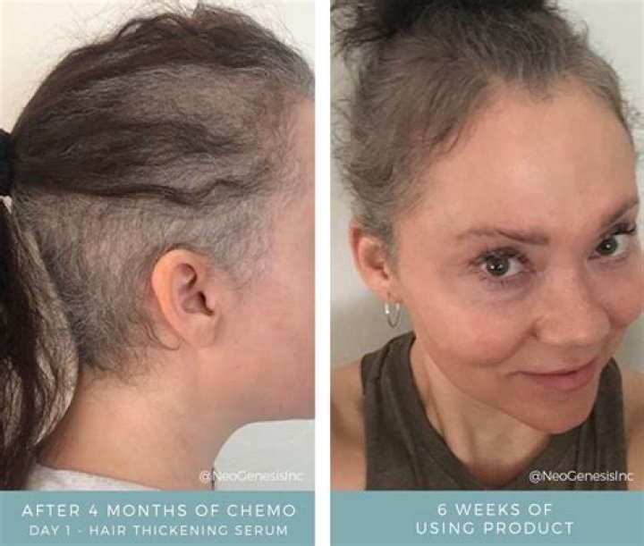 How can I speed up hair growth after chemo?
