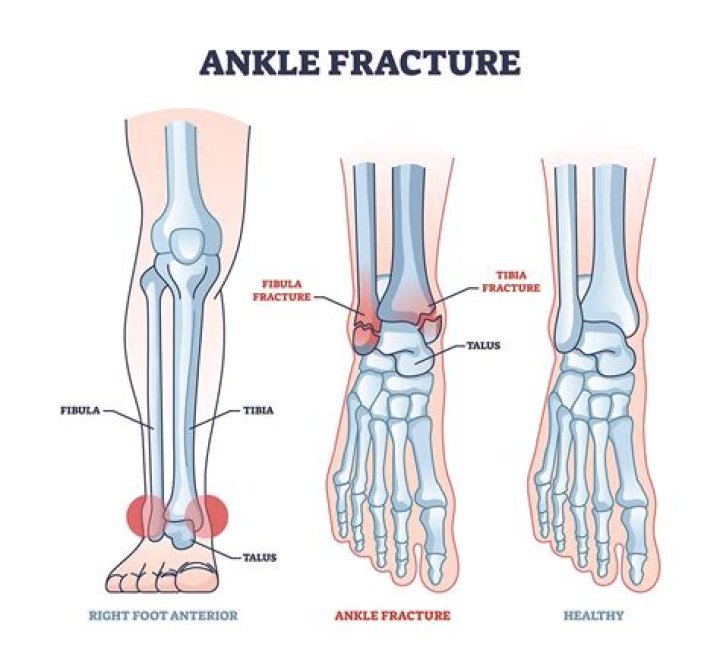 How can u tell if u broke ur ankle?