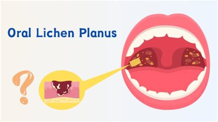 How did I get lichen planus?