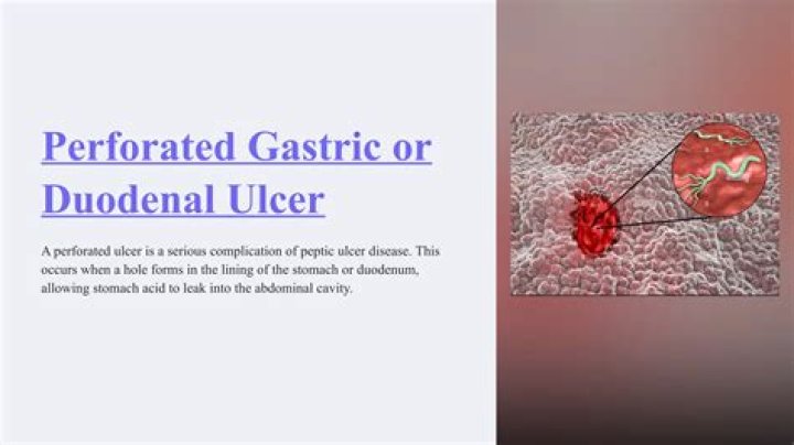 How do you get a perforated ulcer?