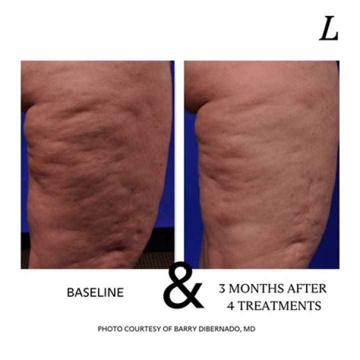 How do you get rid of cellulite after 40?