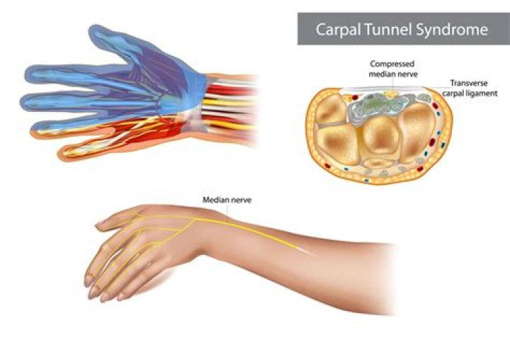 How do you know when carpal tunnel is severe?
