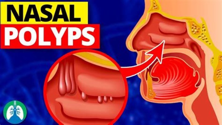 How do you stop nasal polyps from coming back?