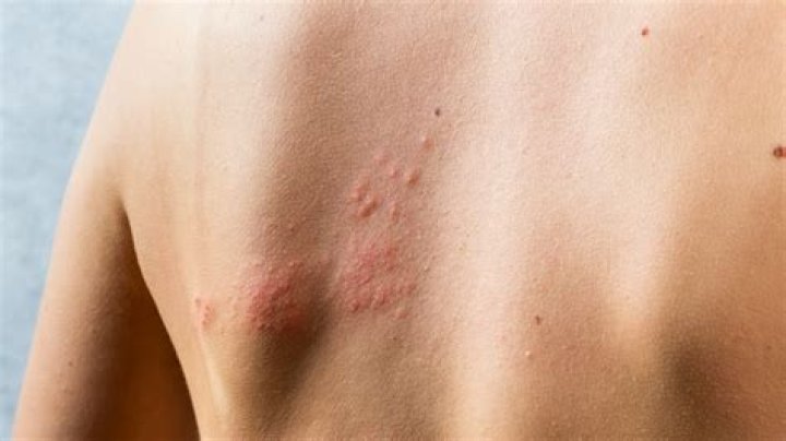 How long are you contagious with shingles?