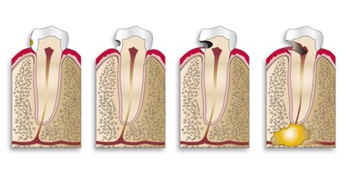 How long does a cavity take to form?