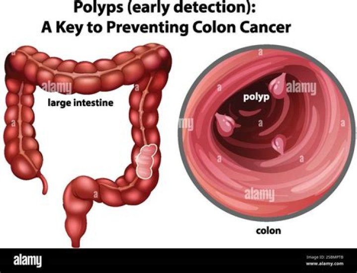 How long does it take for a colon polyp to turn into cancer?