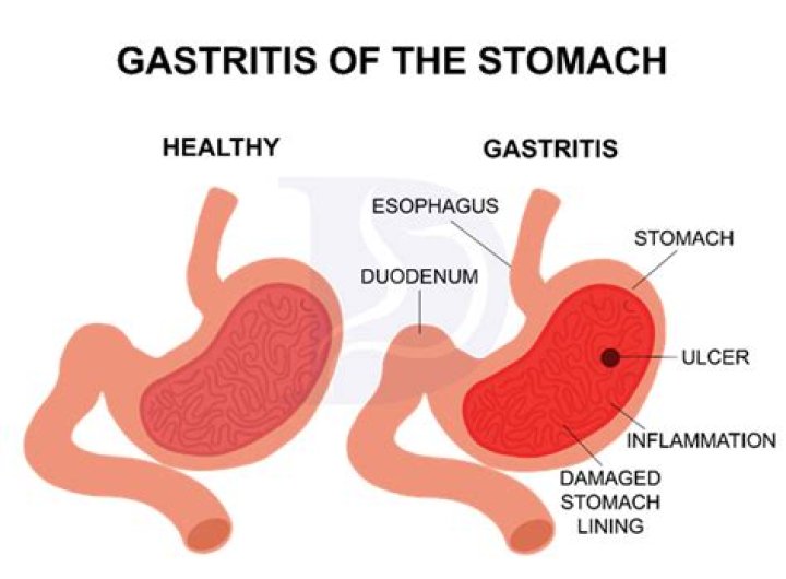 How long does it take for stomach lining to heal from gastritis?