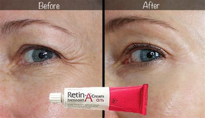 How long does Retin-A last?