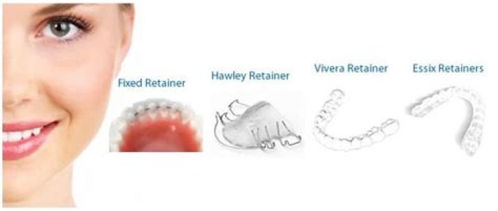 How much does a permanent retainer cost?