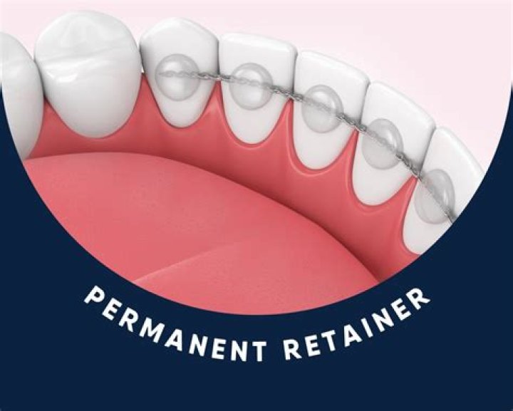 Is braces a permanent fix?