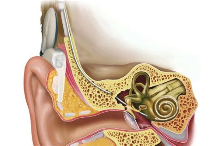 Is cochlear implant a major surgery?