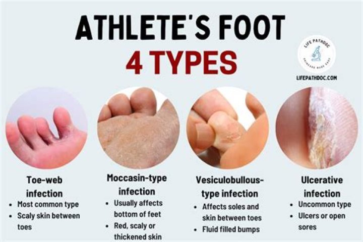 Is it athlete's foot or dry skin?