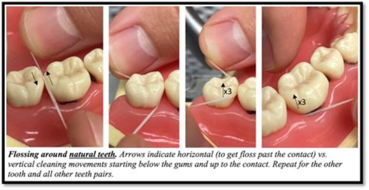 Is it OK to floss around a crown?