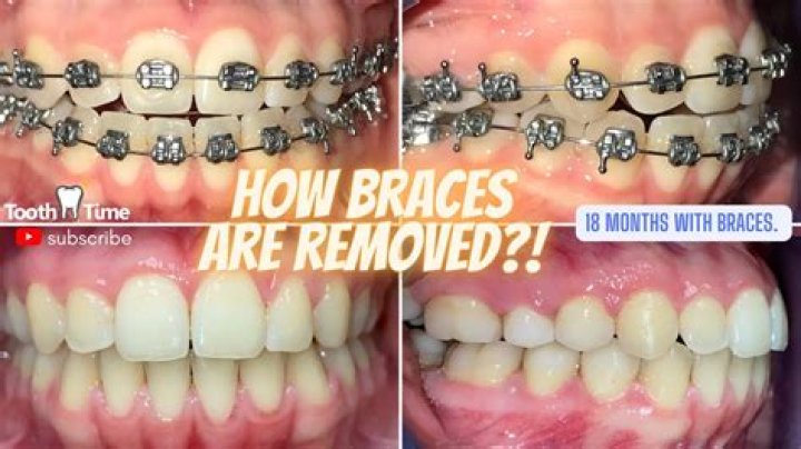 What's the longest time you can have braces?