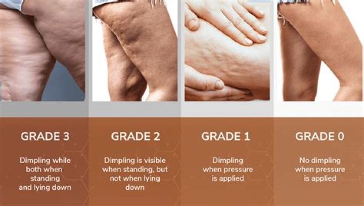 What age do you start getting cellulite?