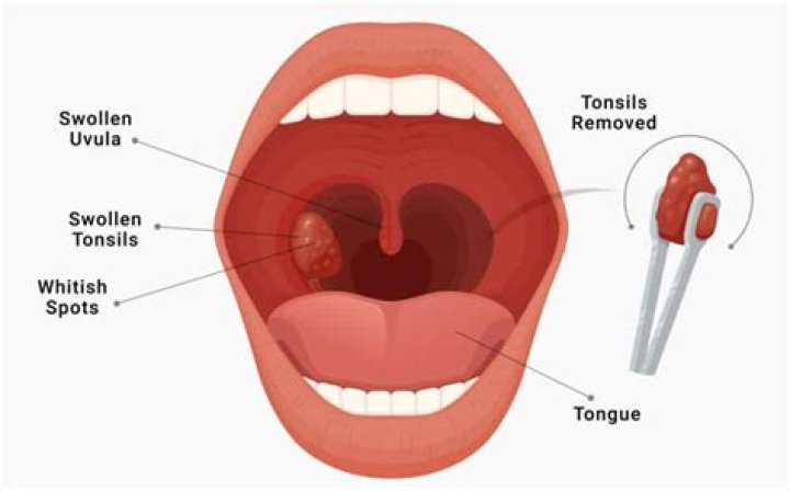What are the cons of getting tonsils removed?