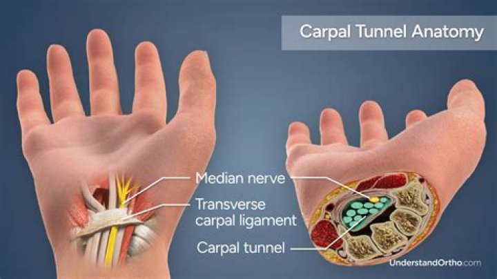 What are the stages of carpal tunnel syndrome?