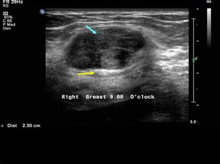 What diseases can be detected by ultrasound?