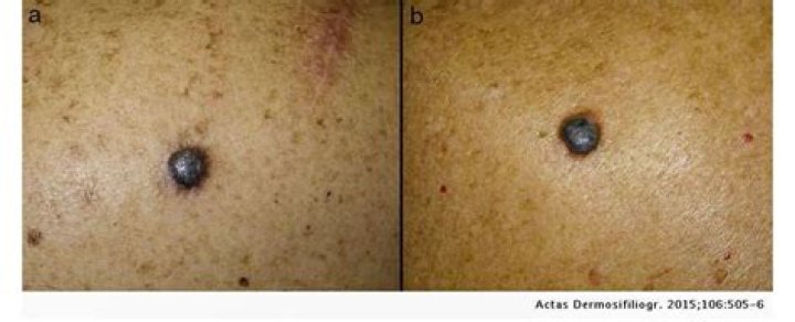 What do cancerous brown spots look like?