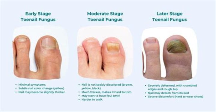 What does a grey toenail mean?