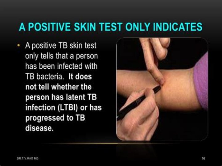 What does a positive skin test for TB look like?