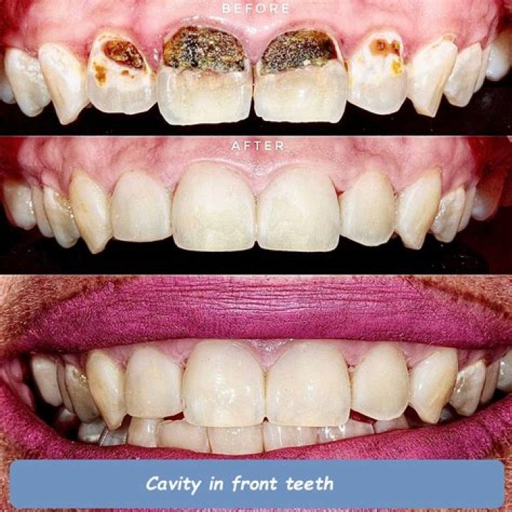 What does a tooth cavity smell like?