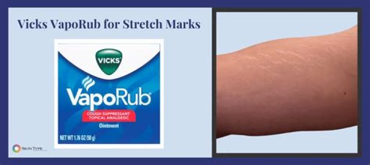What does it mean when Vicks burns?