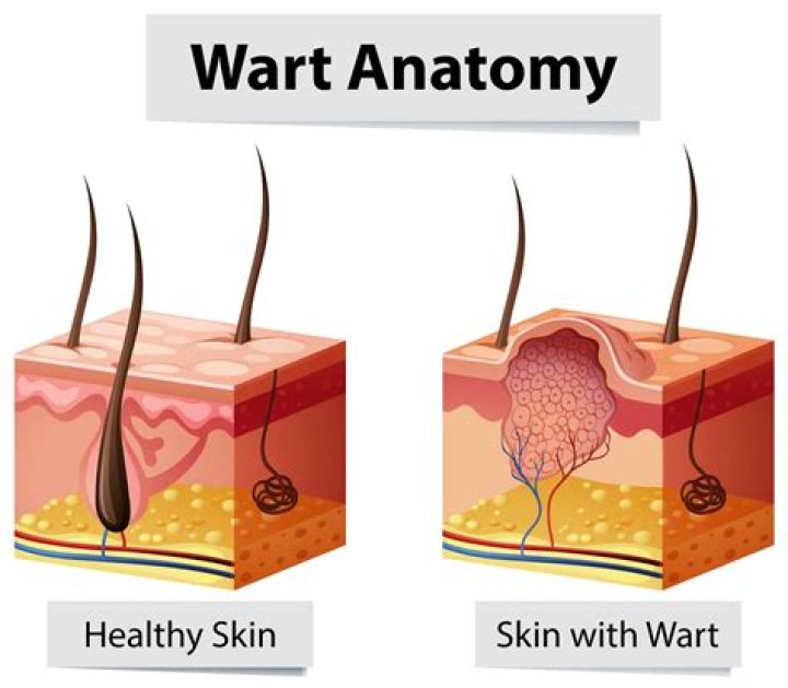 What does it mean when wart turns white?