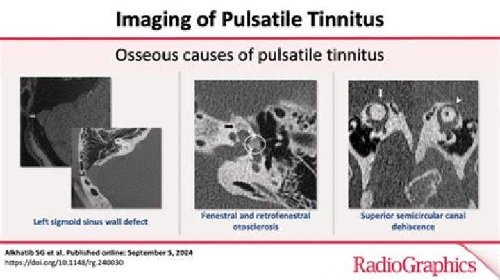 What does the pitch of tinnitus mean?