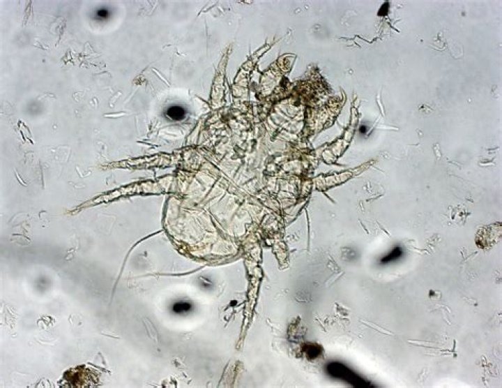 What is a dandruff worm?